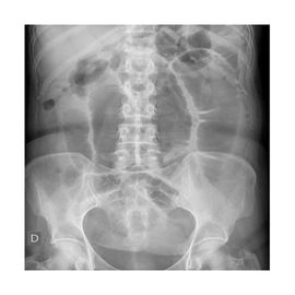 Radiografía de Abdomen, 2 posiciones - HSJ