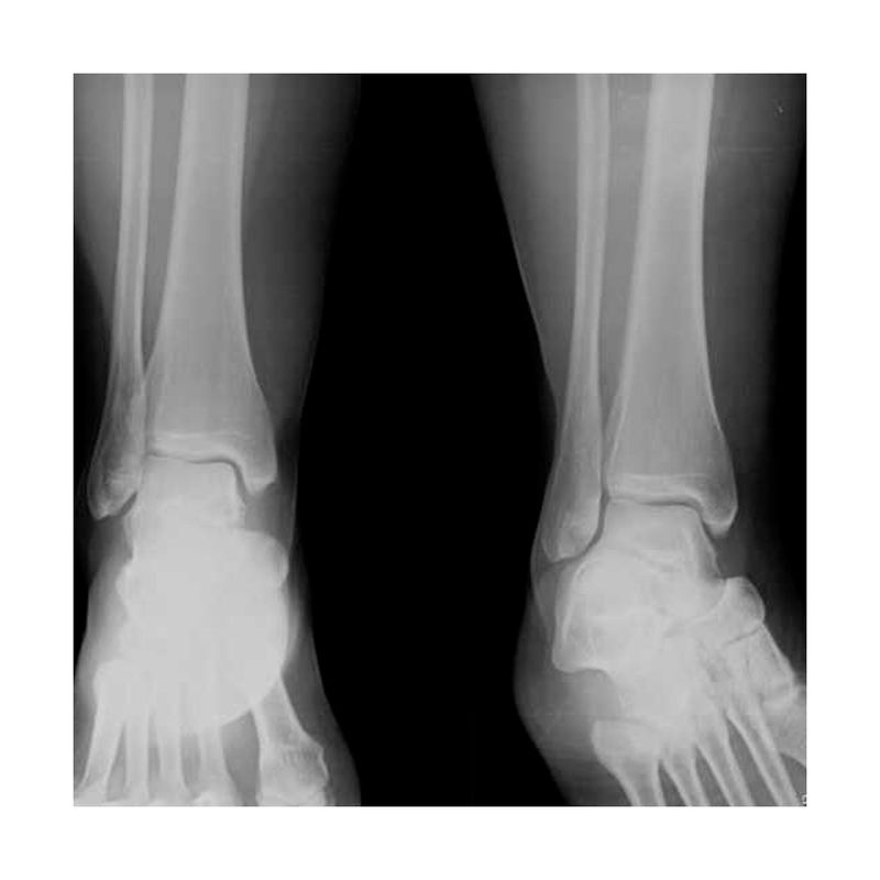 Radiografia-de-Tobillo-2-posiciones-A