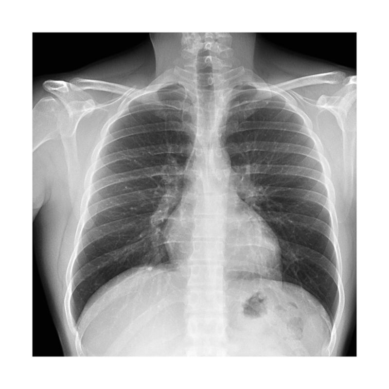 Radiografia-de-Torax-1-posicion-A