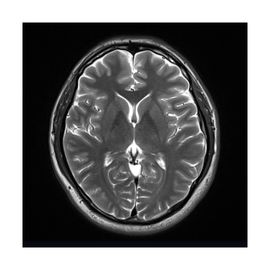 Resonancia Magnética de Cerebro Simple - HSJ