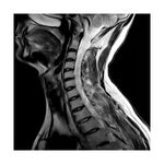 Resonancia-Magnetica-de-Columna-Cervical-A