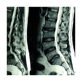 Resonancia Magnética de Columna Lumbar - HSJ