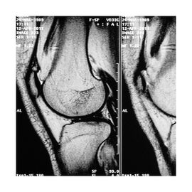 Resonancia Magnética de Rodilla - HSJ