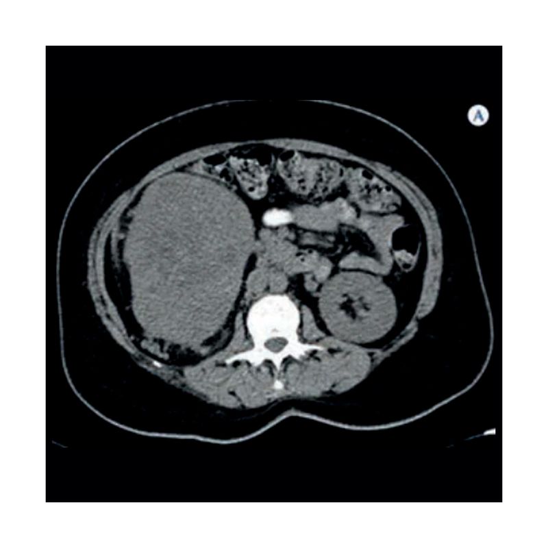 Tomografia-Urologico-Simple-A