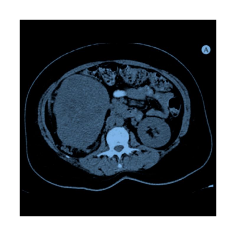 Tomografia-Urologico-Simple-B