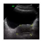 Ultrasonido-Prostatico-Transabdominal-A