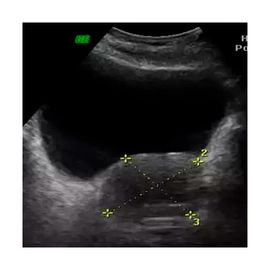 Ultrasonido Prostático Transabdominal - HSJ