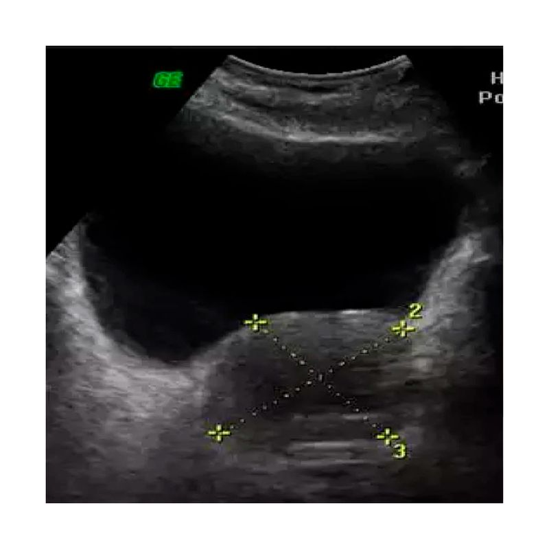 Ultrasonido-Prostatico-Transabdominal-A