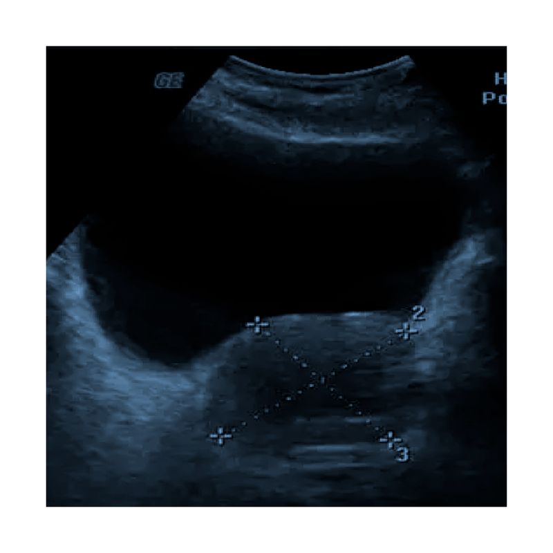 Ultrasonido-Prostatico-Transabdominal-B